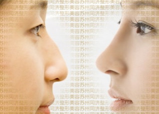 隆鼻手术后生活中要注意什么（隆鼻手术后生活中要注意什么事项）