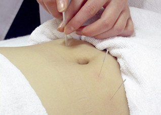 女人针灸减肥要避开的致命陷阱 女人针灸减肥要避开的致命陷阱是什么