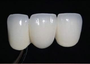 介绍烤瓷牙的五大材料（最好的烤瓷牙是什么材料的）