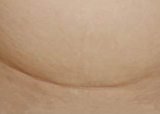 新妈剖腹产后疤痕如何修复 新妈剖腹产后疤痕如何修复的