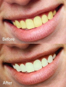 如何对牙齿进行美白（如何对牙齿进行美白治疗）