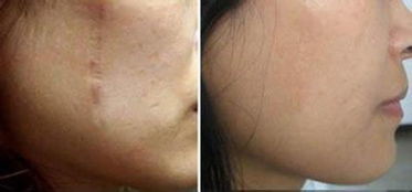 常见疤痕修复疗法（常见疤痕修复疗法图片）