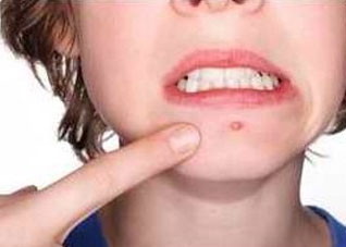 祛痘不当会带来哪些危害 祛痘不当会带来哪些危害图片