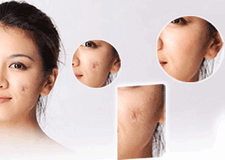 如何去疤痕之皮肤扩张器 疤痕 扩张器