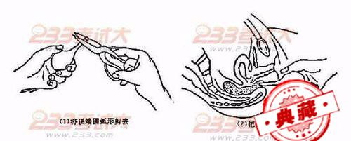 老年习惯性便秘的预防和治疗（老年顽固性便秘）