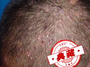 头皮毛囊炎怎么治疗（女性头皮毛囊炎怎么治疗）