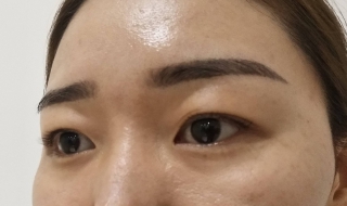 下眼皮松弛怎么办（下眼皮松弛皱纹怎么办）