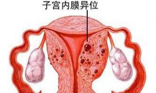 子宫内膜移位怎么办 子宫内膜异位症怎么治疗