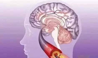 得了脑血栓怎么办 得了脑血栓怎么办理病退