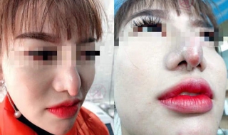 鼻子歪怎么办 鼻子歪了是怎么回事