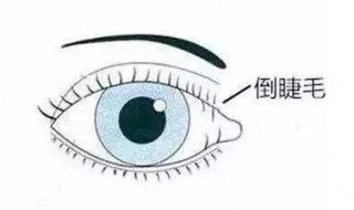 眼睫毛倒长怎么办 眼睫毛倒长怎么办还得手术?