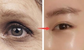 眼角有鱼尾纹怎么办 眼角长鱼尾纹该怎么办