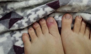 得了甲沟炎怎么办 得了甲沟炎怎么办,如何治愈