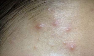 额头起痘痘怎么办 额头突然起痘痘是什么原因造成的