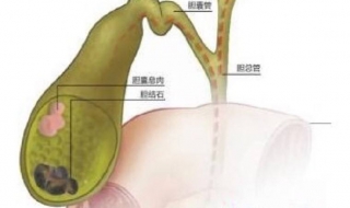 得了胆囊结石怎么办（得了胆囊结石怎么办,教你用鸡内金加一味药）