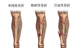 骨折病人不能吃什么（骨折了吃什么食物好得快）