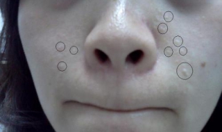 脸上长痘痘怎么调理 皮肤问题在线咨询免费