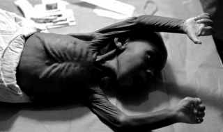 宝宝营养不良 宝宝营养不良有哪些症状