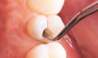 牙缝臭怎么办（口腔牙缝里口臭怎么办）