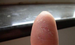 手蜕皮怎么办 四岁孩子手蜕皮怎么办