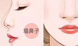 塌鼻梁怎么办（鼻梁几岁定型）
