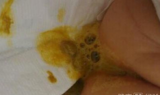 新生宝宝拉稀怎么办 新生儿宝宝拉稀怎么办?
