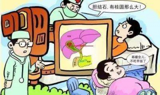 有胆结石怎么办 有胆结石吃什么可以化掉