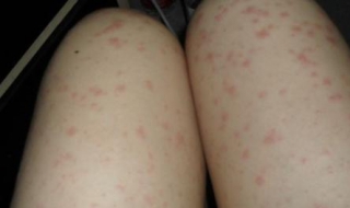 腿部皮肤过敏怎么办（腿部皮肤过敏怎么办图片）