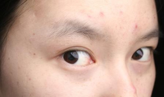 满脸痤疮怎么办 满脸痤疮怎么办图片