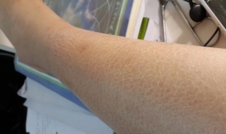 腿上皮肤干燥怎么办（腿上皮肤干燥起皮屑怎么办）