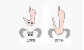 胃下垂怎么办（胃下垂怎样把胃提上去）