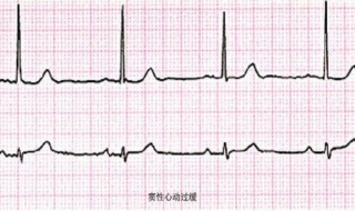 窦性心动过缓怎么办 冠心病患者窦性心动过缓怎么办