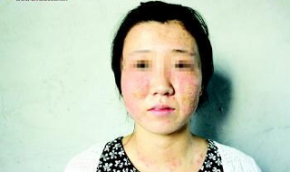 过敏脸肿了怎么办（过敏了脸肿了怎么办）