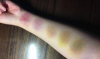 乌青怎么办（乌青怎么办呢）