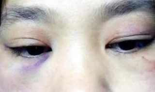 脸被打肿了怎么办（脸被打肿了怎么办才能消肿）