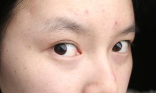 脸上青春痘怎么办（脸上有青春痘怎么去除）