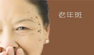 脸上长老年斑怎么办（脸上长老年斑怎么办 怎样去除最有效）