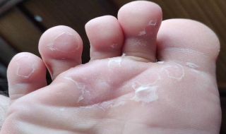脚底脱皮怎么办 脚底总是脱皮是什么原因
