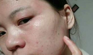 孕妇脸部过敏怎么办 孕妇脸部过敏快速解决办法