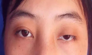 上眼睑下垂怎么办（上眼睑下垂是什么原因）