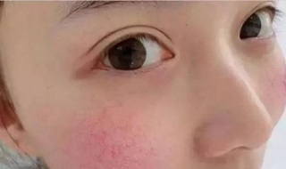 皮肤红血丝怎么办（皮肤红血丝怎么治疗和修复）