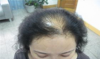 头发稀少怎么办（头发稀少怎么变浓密）