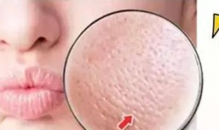 脸上毛孔很大怎么办 脸上毛孔很大怎么办小妙招