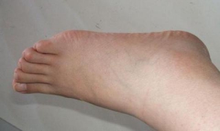 孕妇脚肿怎么办 怀孕脚肿的厉害怎么办