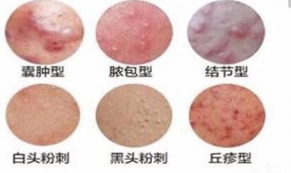 脸上痤疮怎么办 脸上痤疮怎么治疗好得快