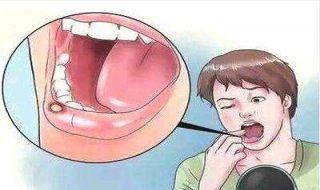嘴巴溃疡怎么办（嘴巴起溃疡怎样快速消除）