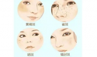 黄褐斑和雀斑的区别（黄褐斑与雀斑的区别是什么）