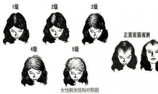 女性脱发怎么办（女性大量脱发该怎么办）
