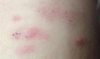 儿童皮肤过敏怎么办 春季儿童皮肤过敏怎么办