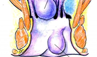 儿童痔疮怎么办 儿童长痔疮怎么办